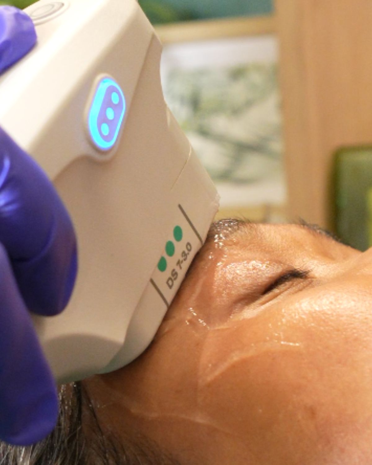 Ultherapy in BGC: Everything You Need to Know About Non-Surgical Face Lifting