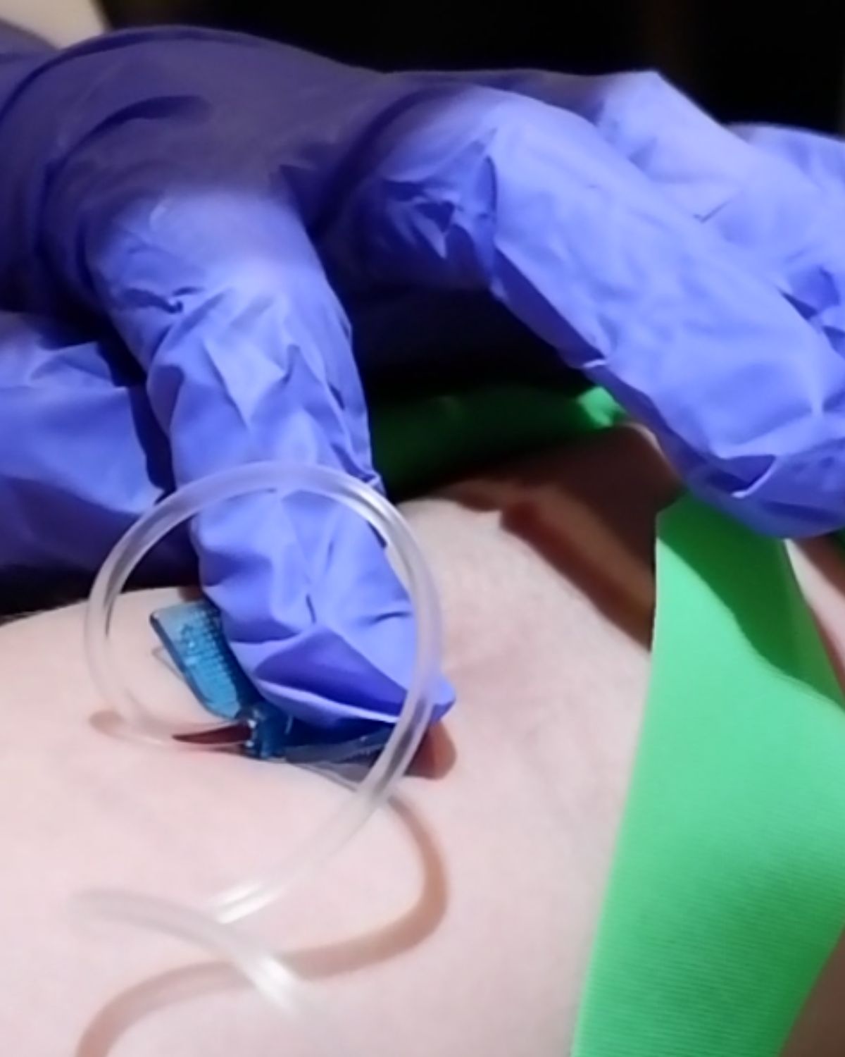 IV drip therapy in BGC at Velasco Medical Aesthetics: sterile butterfly-needle IV access placed by a gloved clinician with proper tourniquet technique.