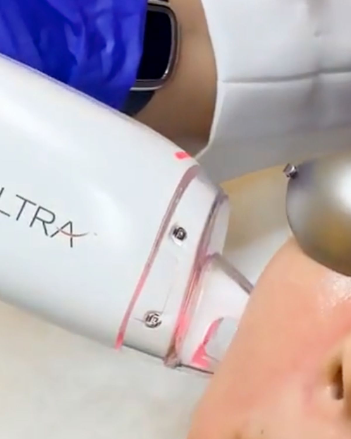 LaseMD Ultra in BGC: An Honest Physician’s Guide to the Thulium Laser Facial